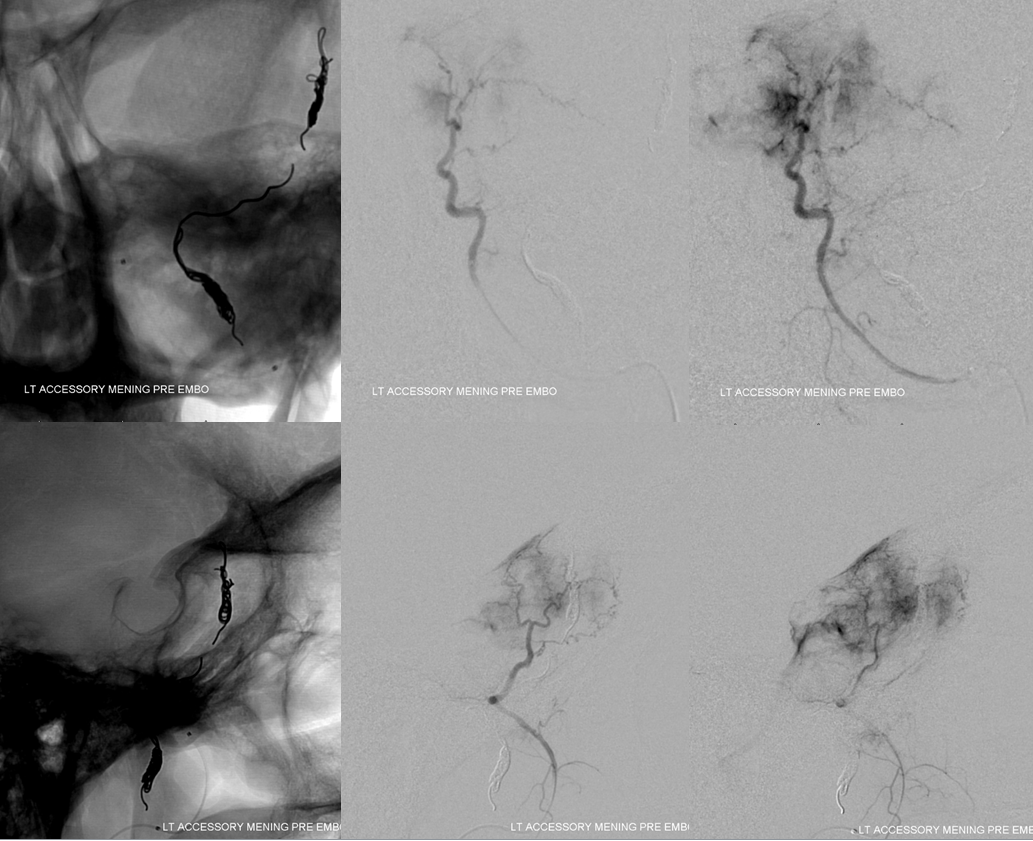 skull base meningioma embo