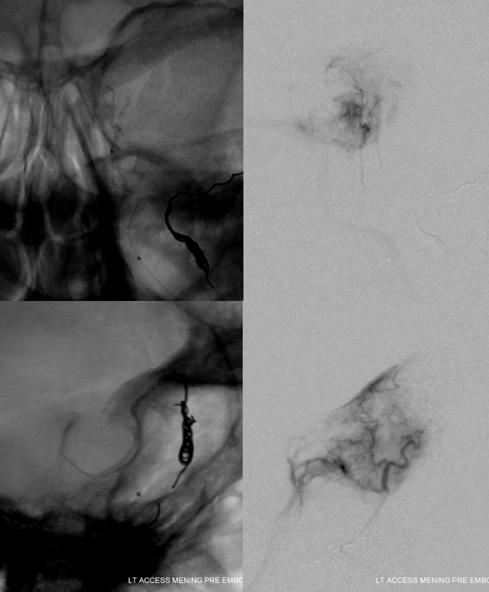 skull base meningioma embo