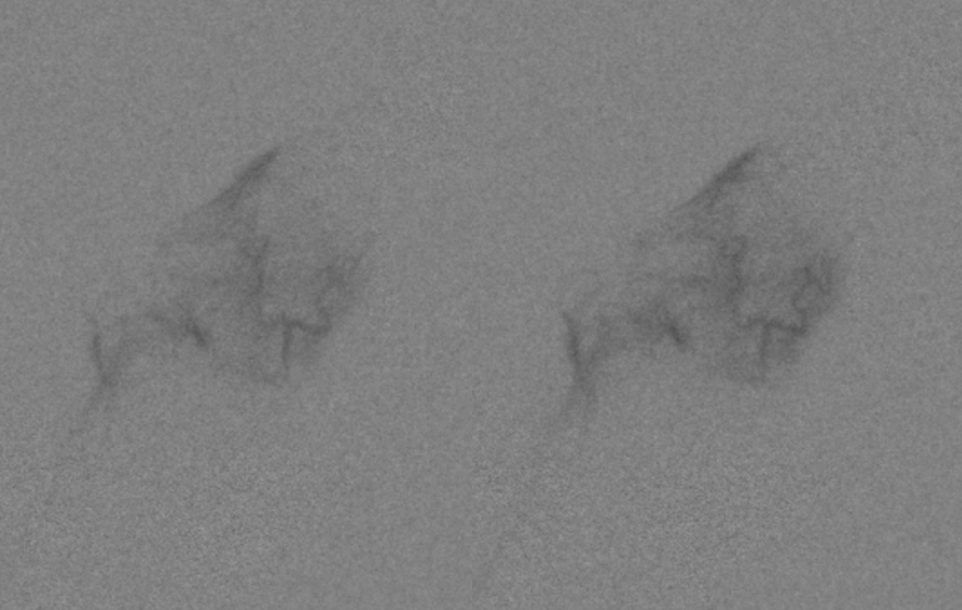 skull base meningioma embo