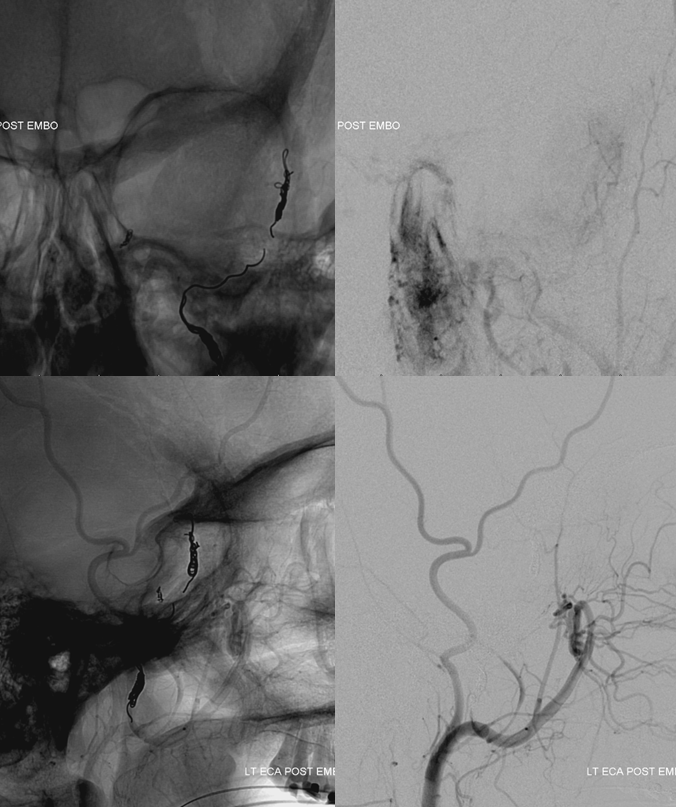 skull base meningioma embo