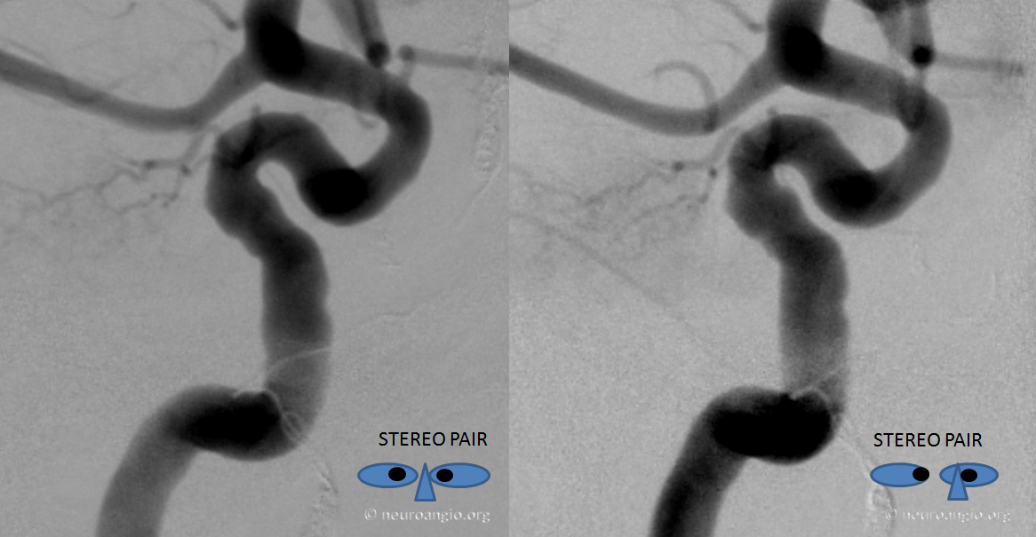 skull base meningioma embo