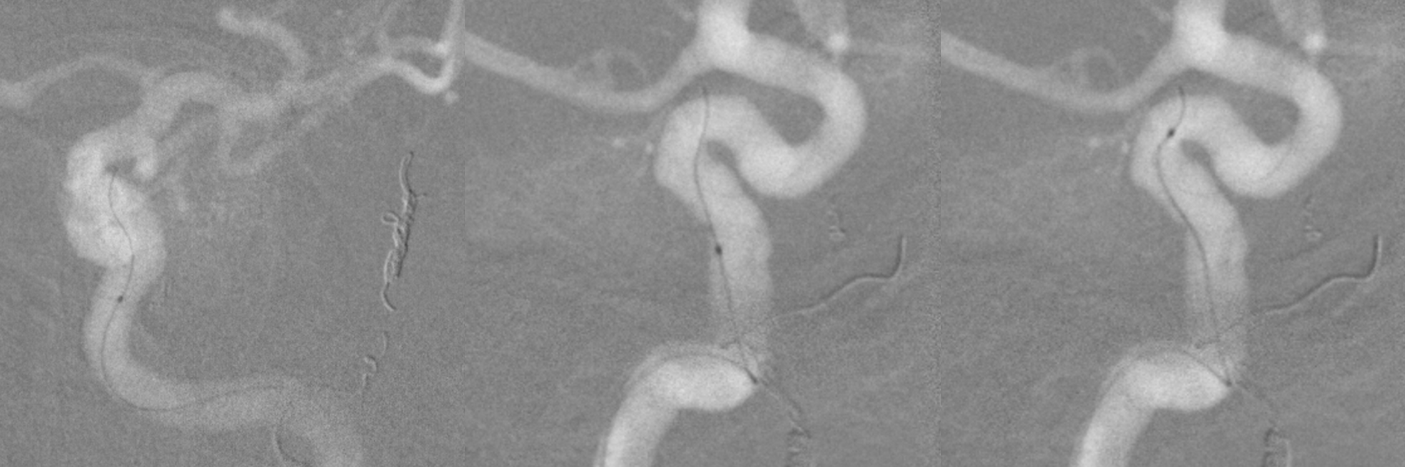 skull base meningioma embo