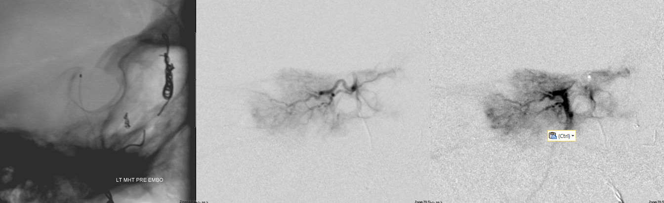 skull base meningioma embo