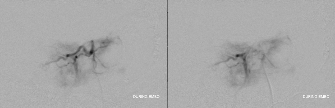 skull base meningioma embo