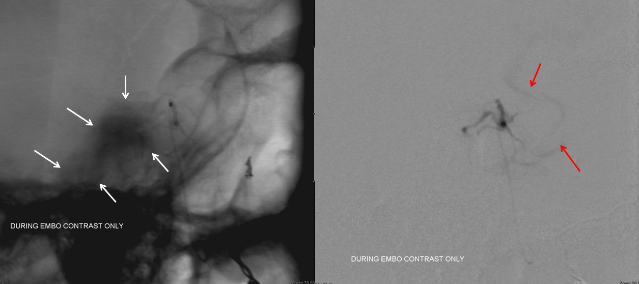 skull base meningioma embo