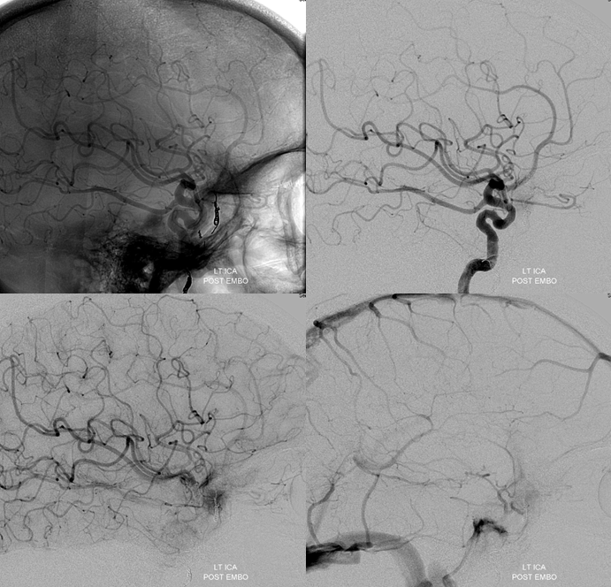 skull base meningioma embo