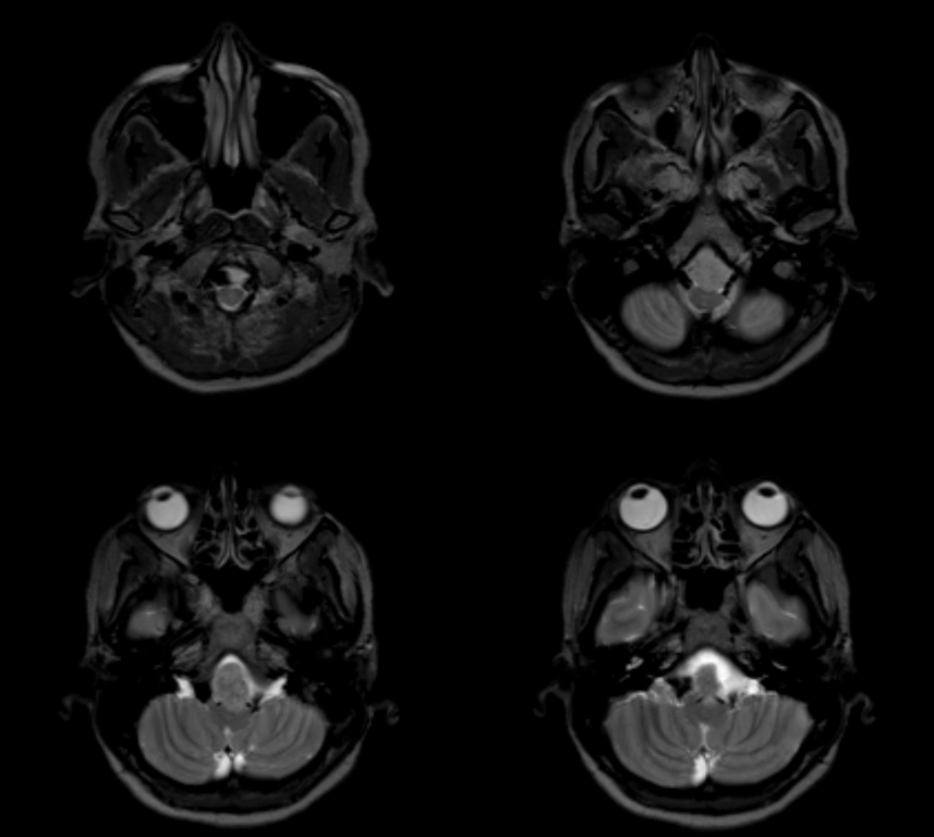 Clival and Foramen Magnum Meningioma