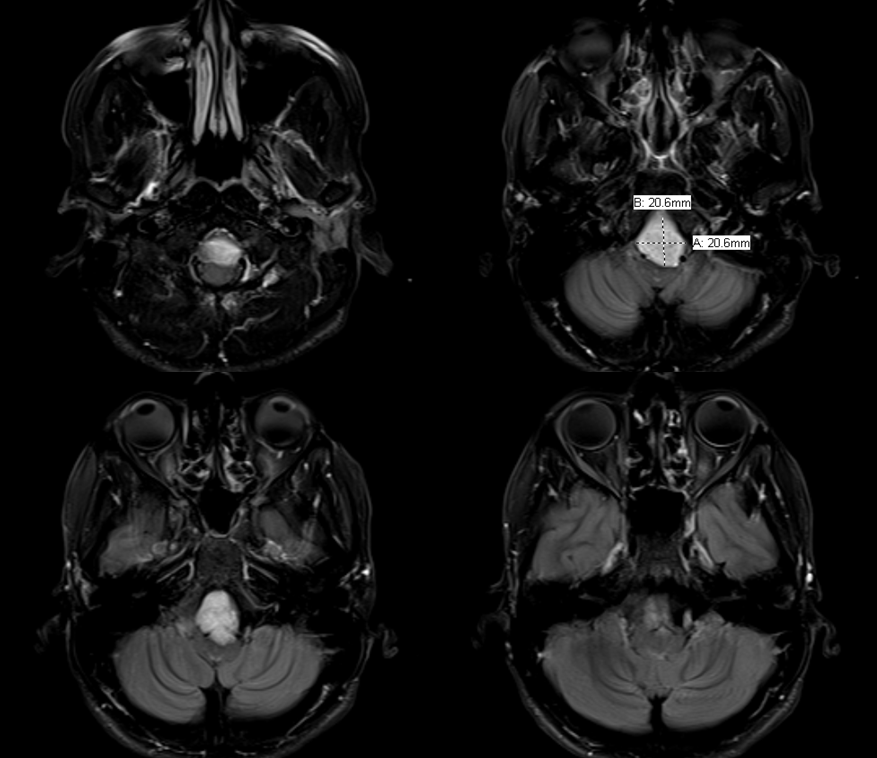 Clival and Foramen Magnum Meningioma