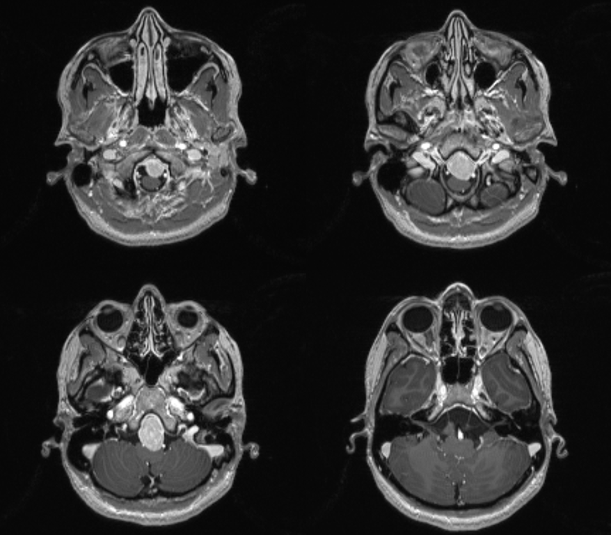 Clival and Foramen Magnum Meningioma