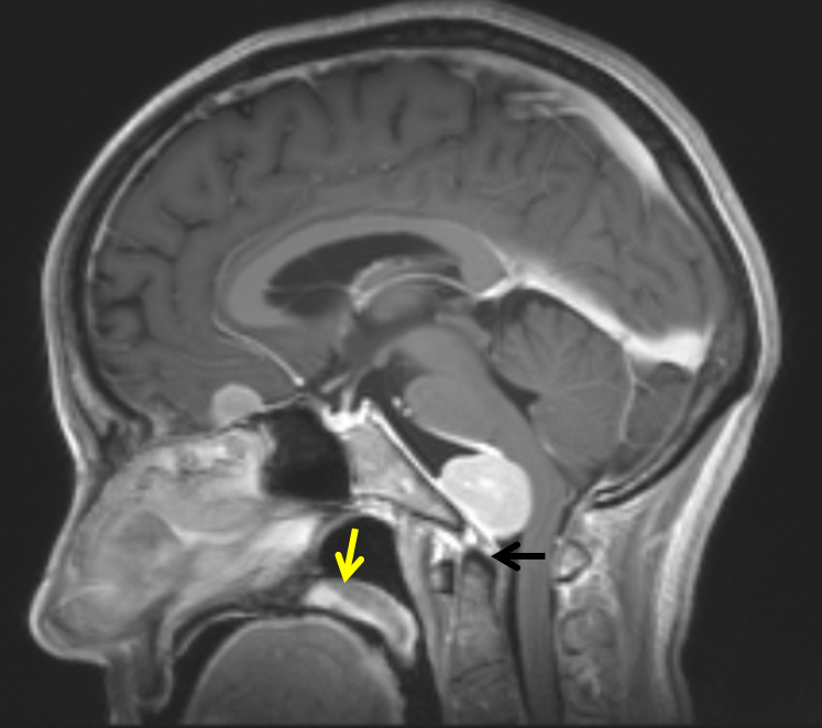 Clival and Foramen Magnum Meningioma