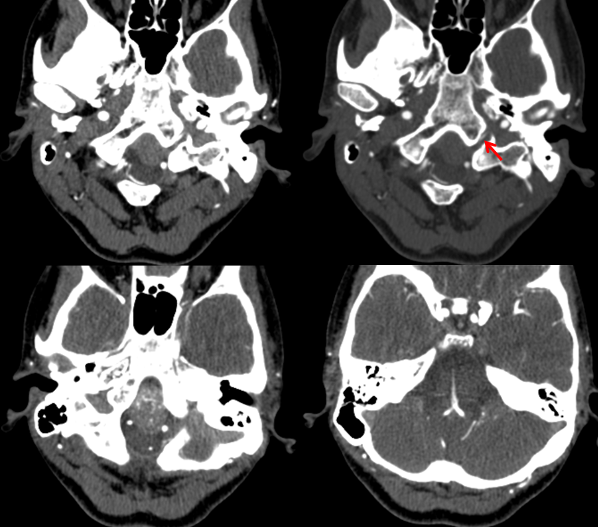 Clival and Foramen Magnum Meningioma