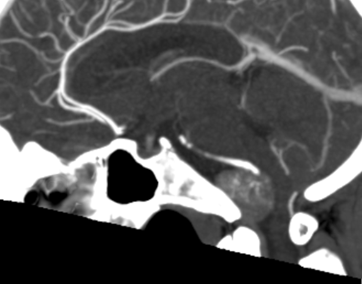 Clival and Foramen Magnum Meningioma