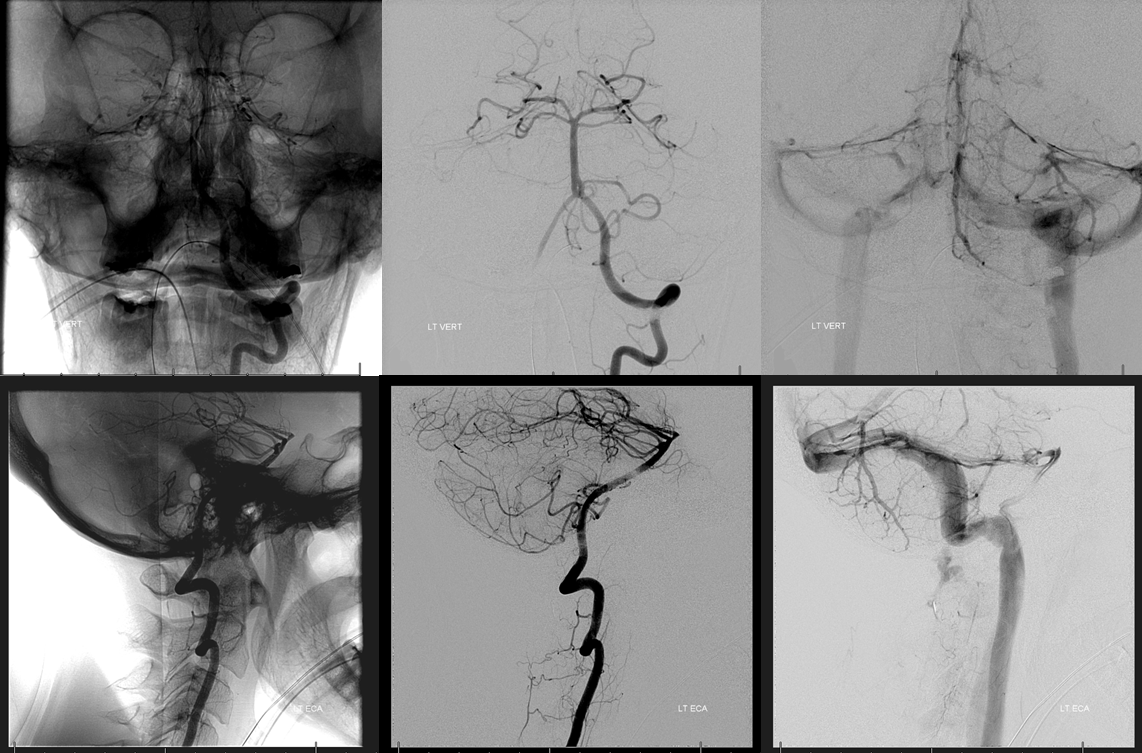 Clival and Foramen Magnum Meningioma