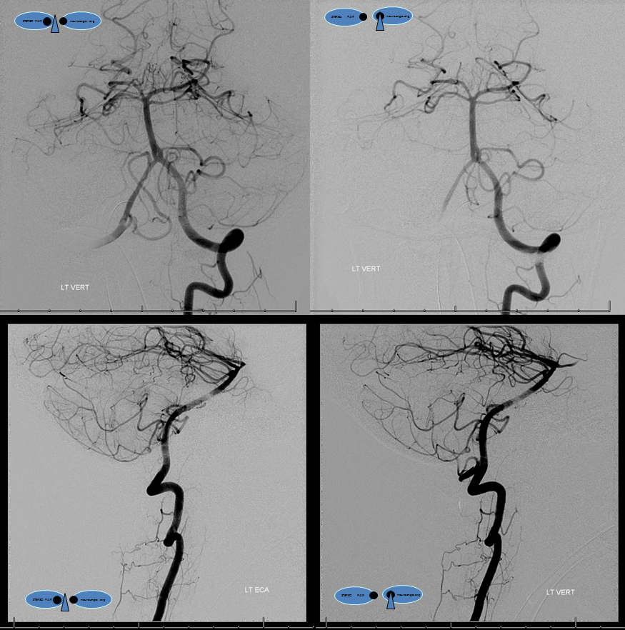 Clival and Foramen Magnum Meningioma