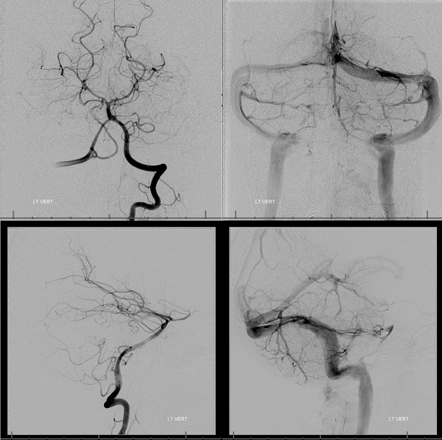 Clival and Foramen Magnum Meningioma