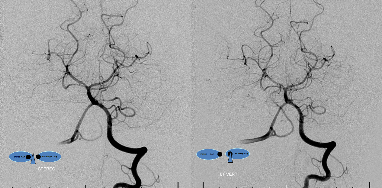 Clival and Foramen Magnum Meningioma