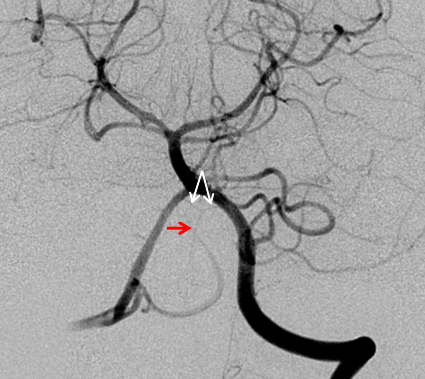 Clival and Foramen Magnum Meningioma