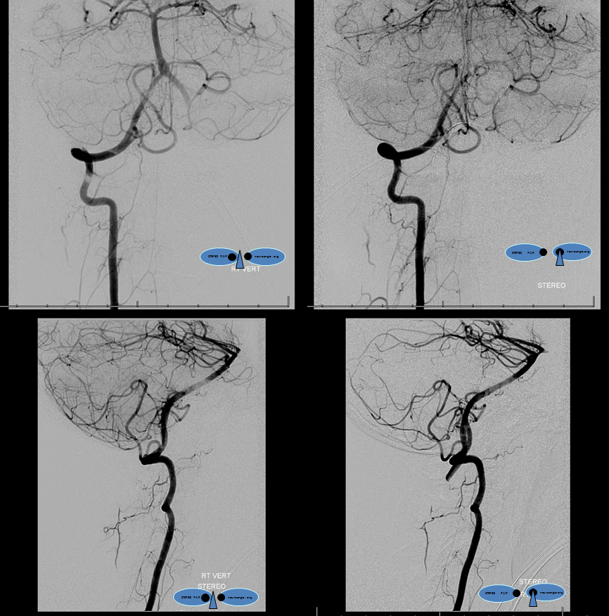 Clival and Foramen Magnum Meningioma