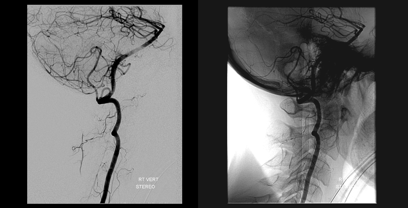 Clival and Foramen Magnum Meningioma