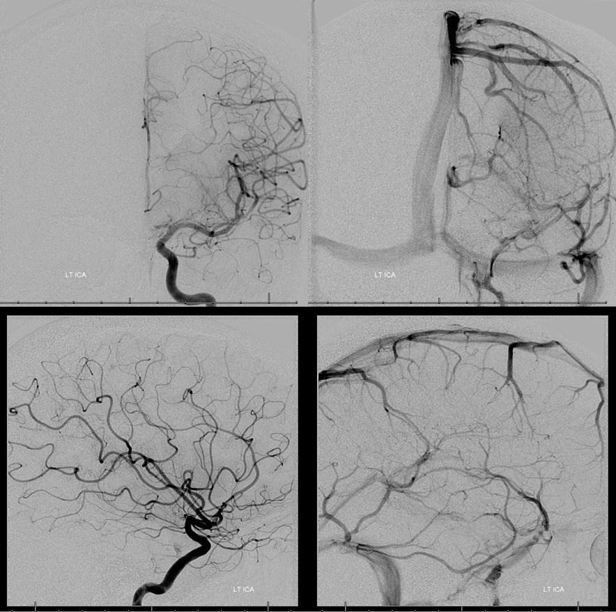 Clival and Foramen Magnum Meningioma