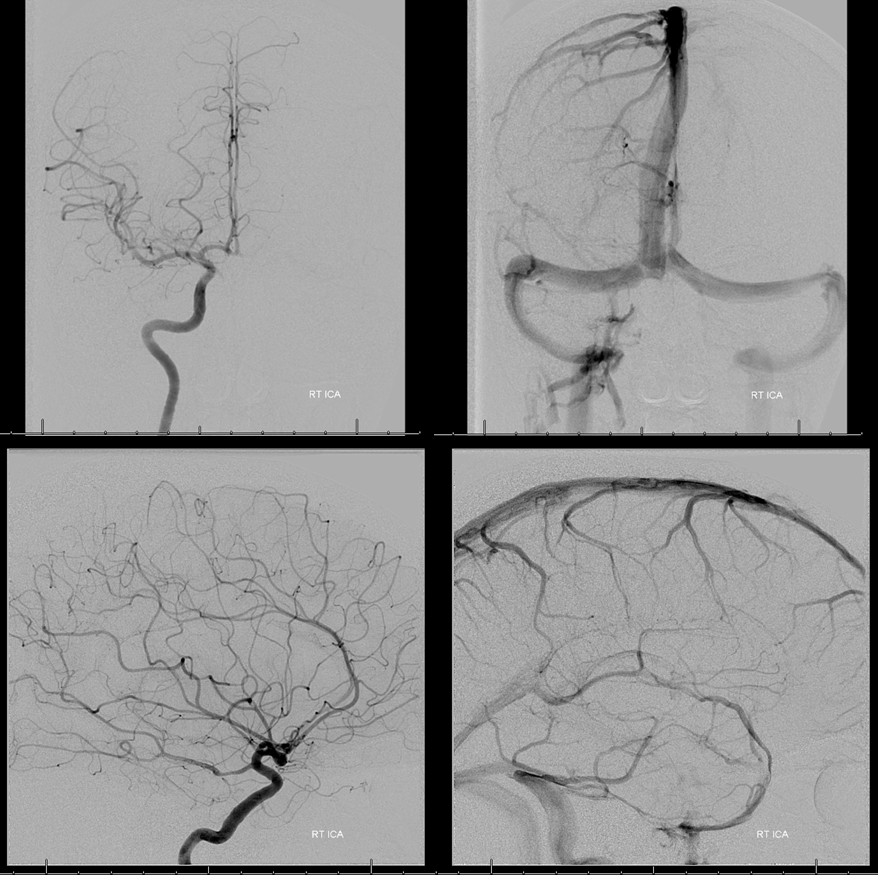 Clival and Foramen Magnum Meningioma