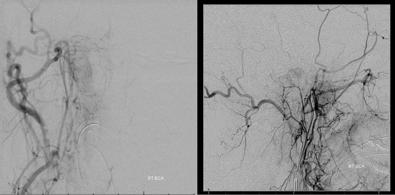 Clival and Foramen Magnum Meningioma