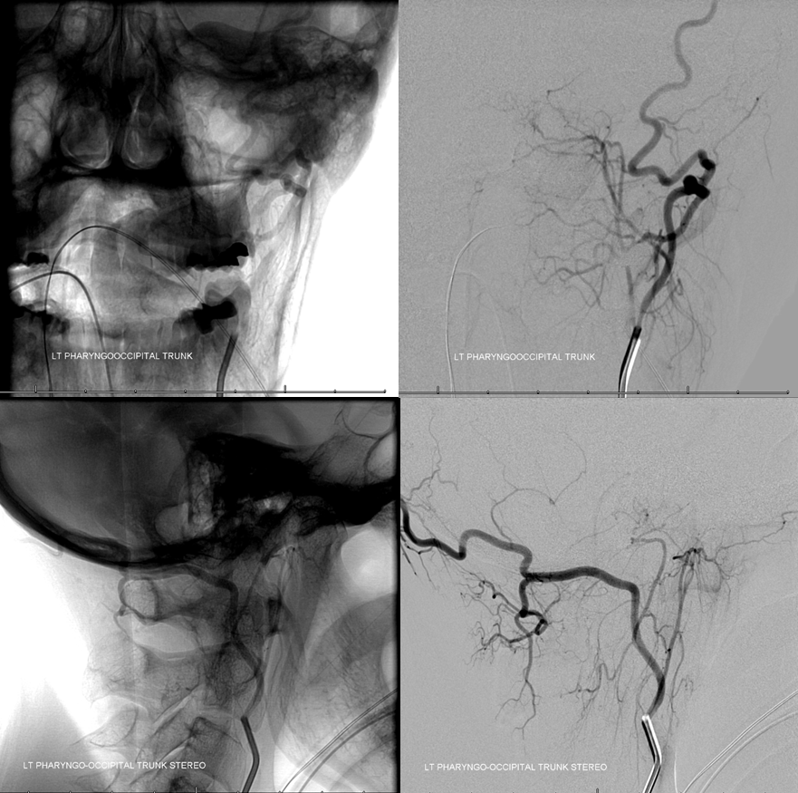 Clival and Foramen Magnum Meningioma