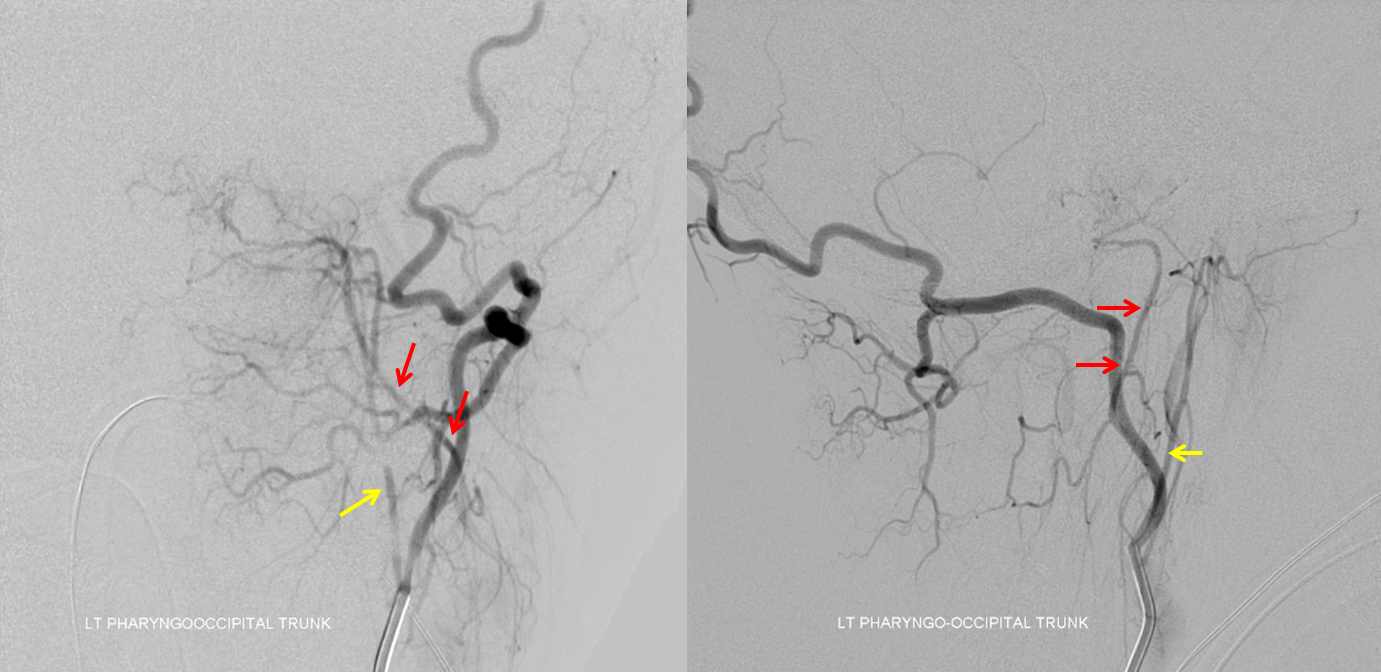 Clival and Foramen Magnum Meningioma