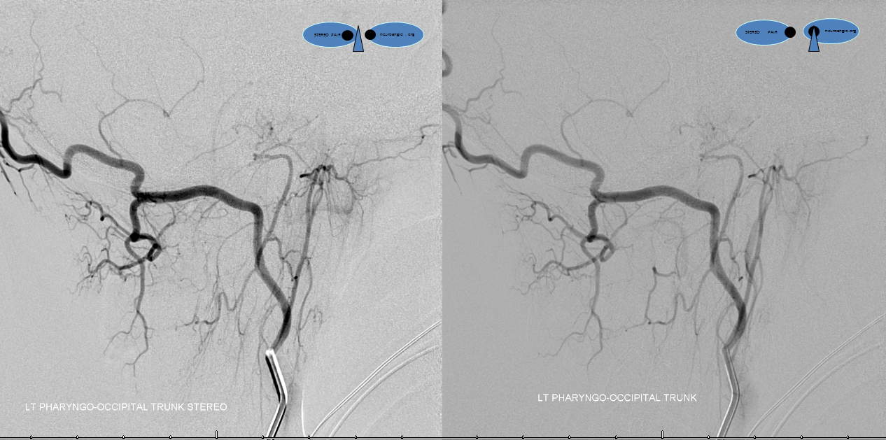 Clival and Foramen Magnum Meningioma