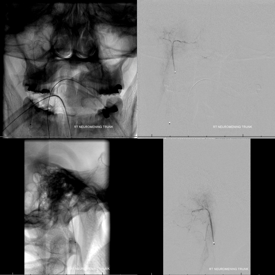 Clival and Foramen Magnum Meningioma