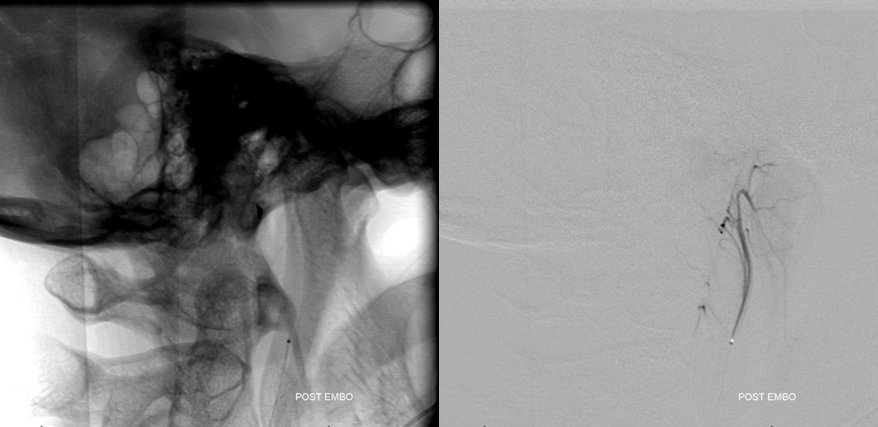 Clival and Foramen Magnum Meningioma