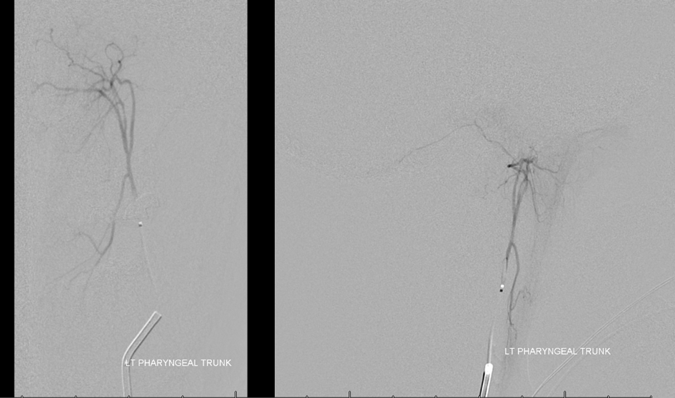 Clival and Foramen Magnum Meningioma