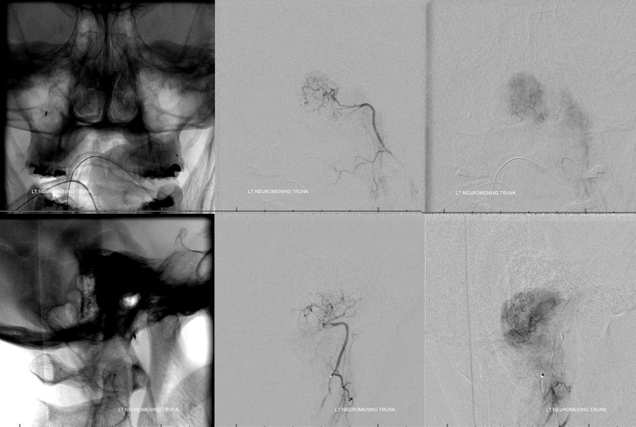 Clival and Foramen Magnum Meningioma