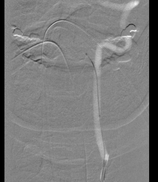 Clival and Foramen Magnum Meningioma