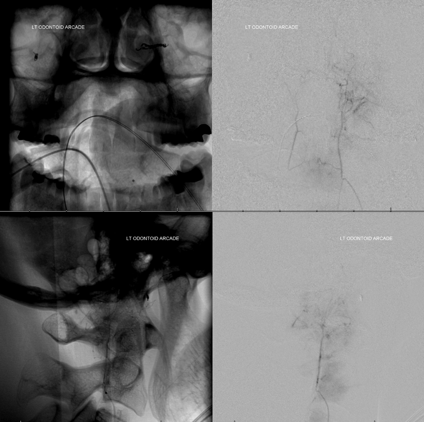 Clival and Foramen Magnum Meningioma