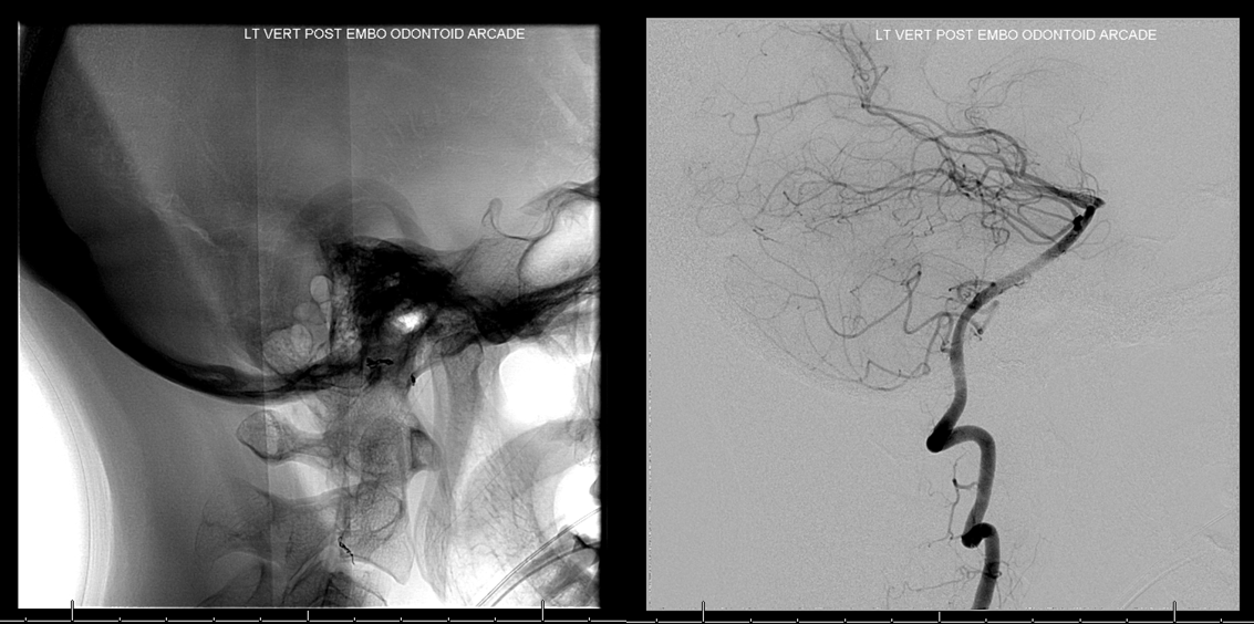 clival and foramen magnum meningioma embo