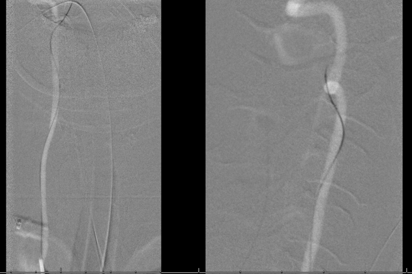 clival and foramen magnum meningioma embo