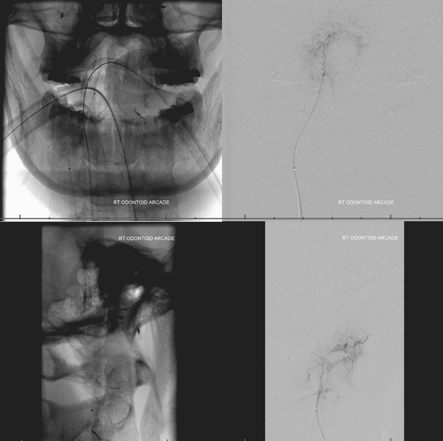 clival and foramen magnum meningioma embo