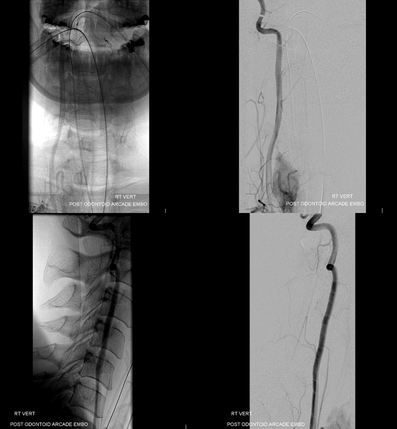 clival meningioma embolization