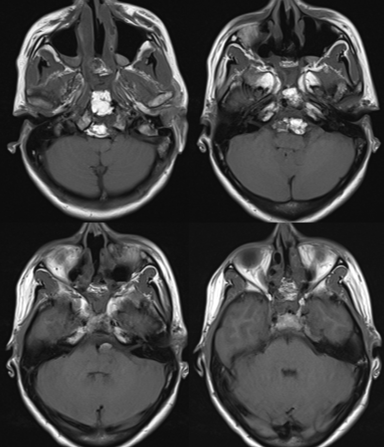 clival meningioma embolization