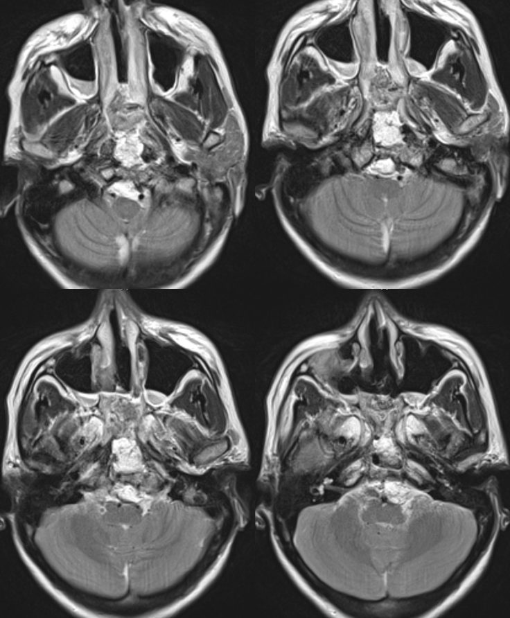 clival meningioma embolization