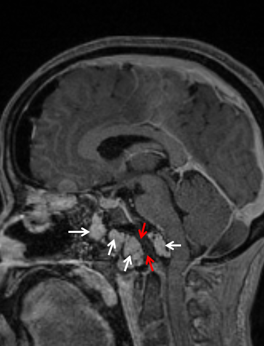 clival meningioma embolization