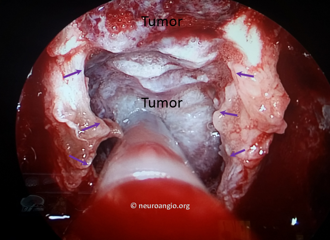 Clival Meningioma Resection Transnasal