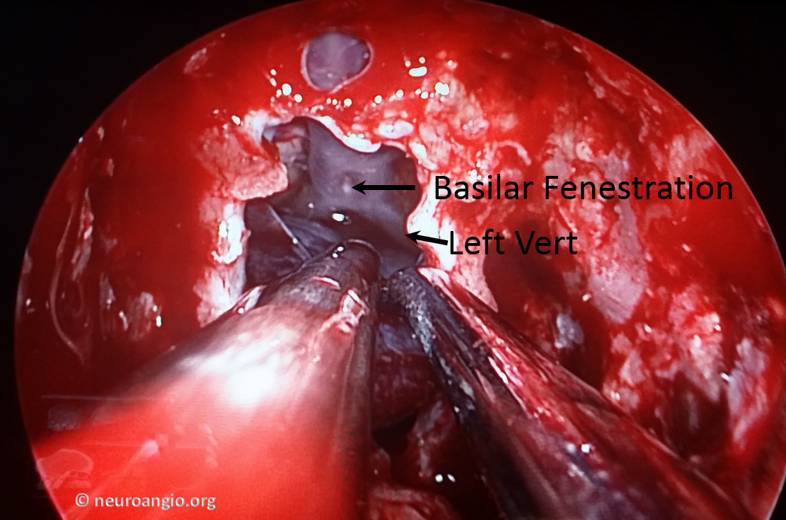 Clival Meningioma Resection Transnasal