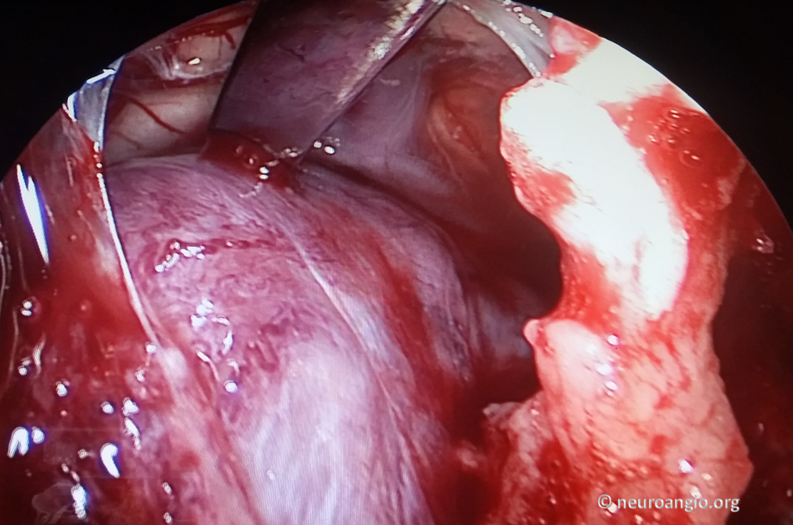 Clival Meningioma Resection Transnasal