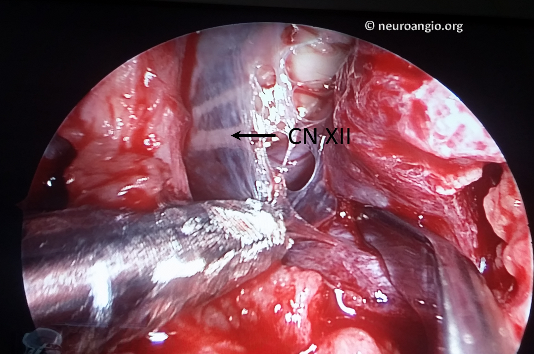 Clival Meningioma Resection Transnasal