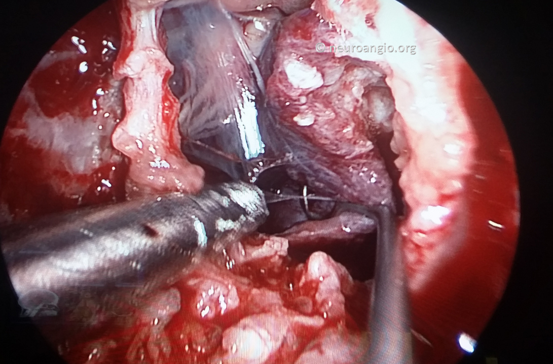 Clival Meningioma Resection Transnasal