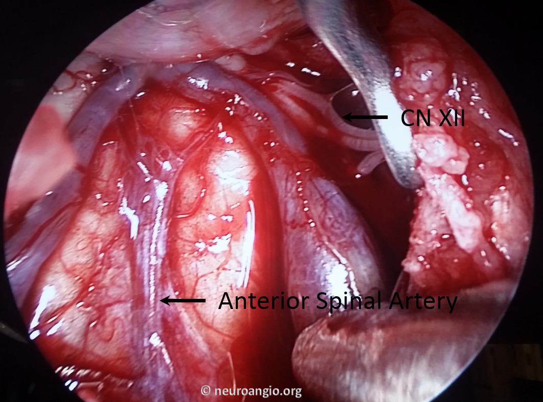 Clival Meningioma Resection Transnasal