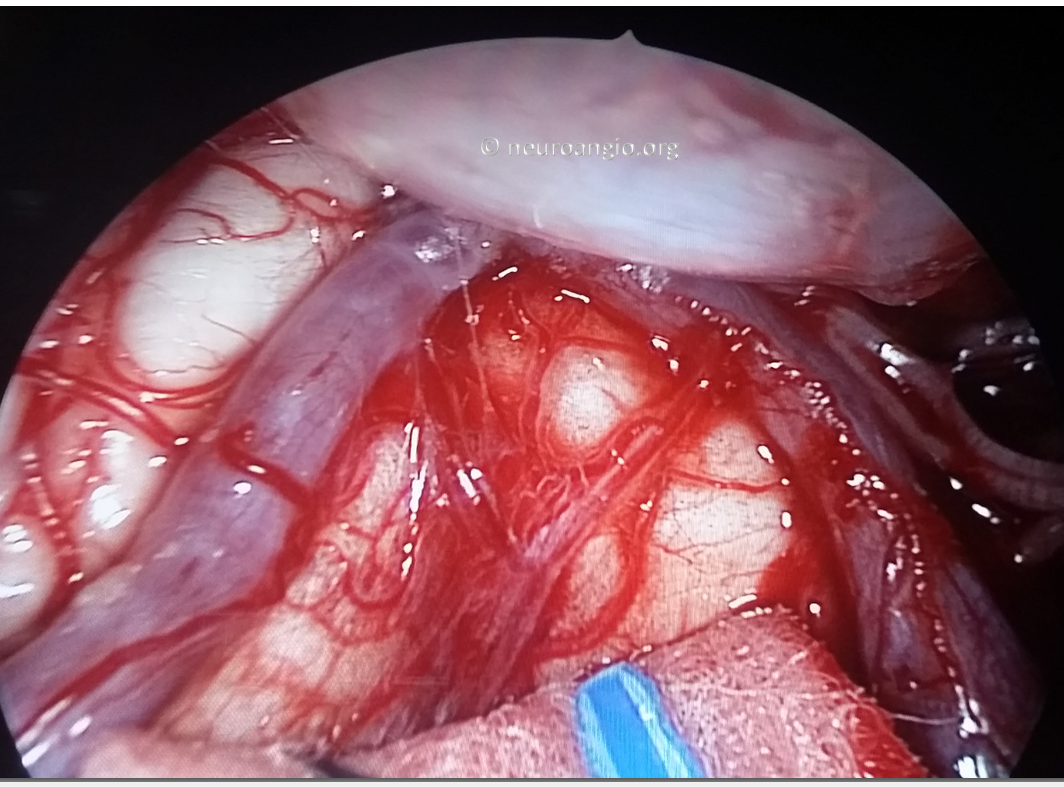 Clival Meningioma Resection Transnasal