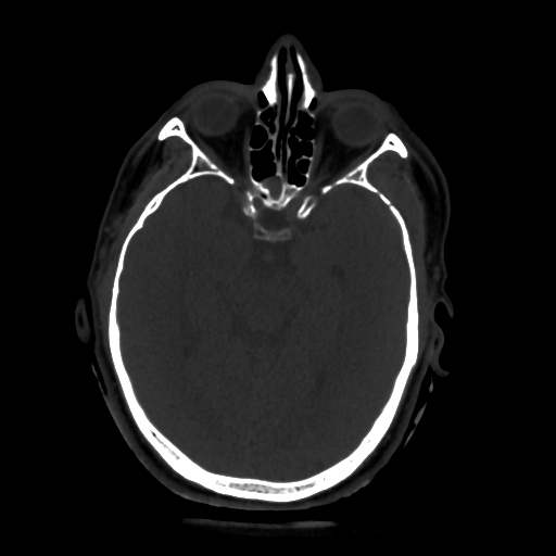 Epidural Hematoma Middle Meningeal Artery Fistula